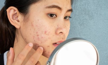 Jerawat Dewasa dan Ini Faktor Penyebab Kemunculannya